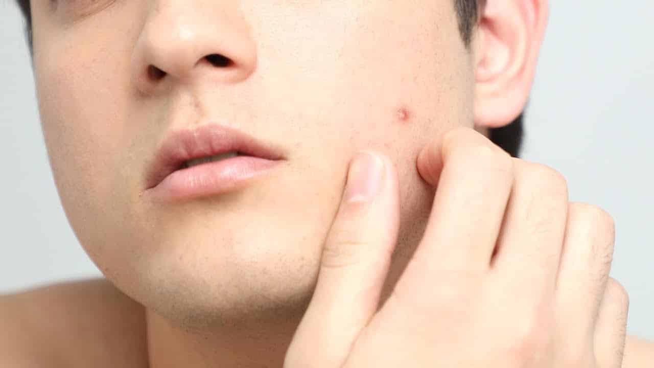 ظهور حب الشباب